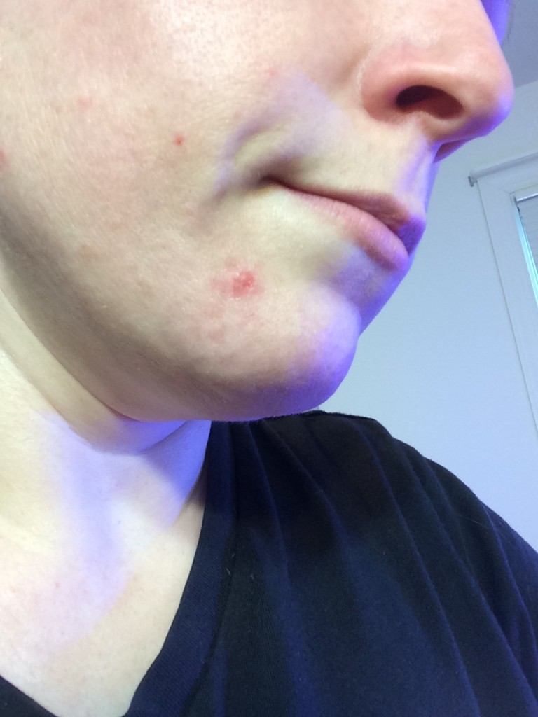 Red Light Therapy Before and After Photos of Cystic Acne Wound Red
