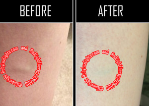 red light therapy before and after leg veins 5