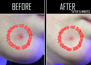 red light therapy before and after photos cystic acne wound 2