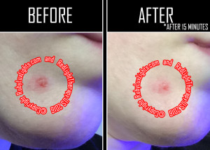 red light therapy before and after photos cystic acne wound 3