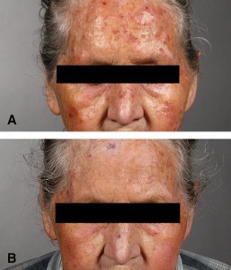 skin cancer before and after photo photodynamic therapy