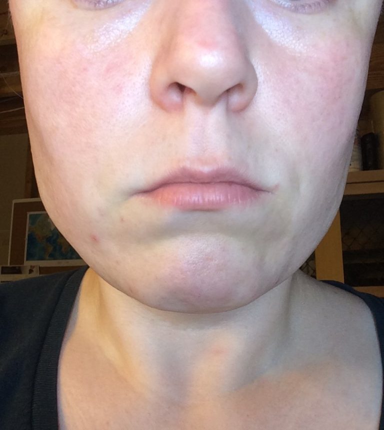 infrared light therapy face before and after